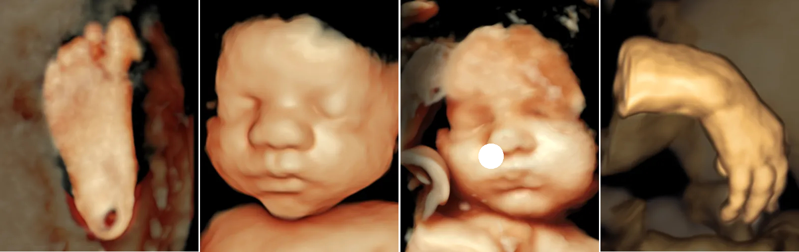 Prenatal ultrasounds (from left) of a foot at 25 weeks, a face at 33 weeks, a face at 34 weeks, and a hand at 23 weeks.