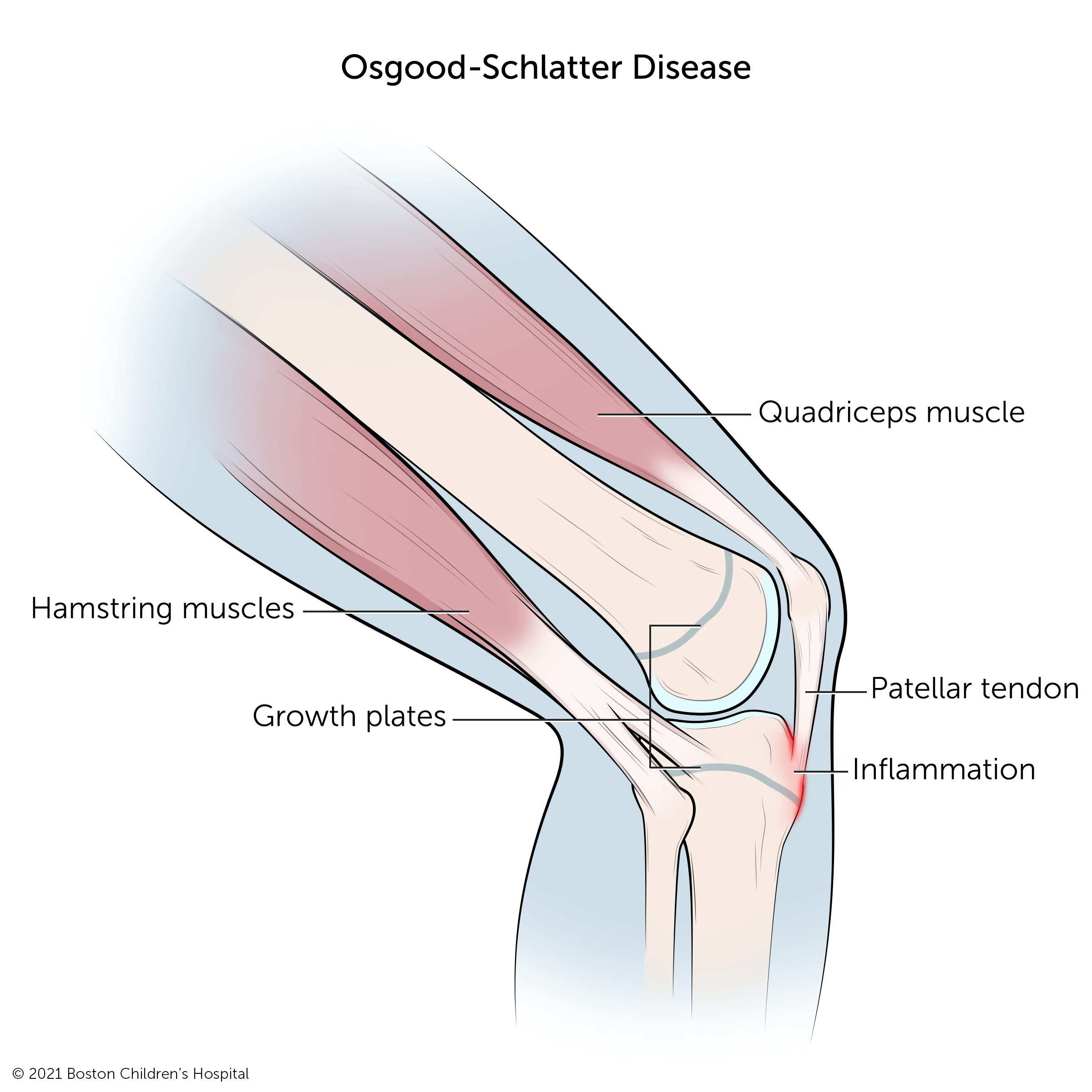 Labeled knee diagram showing Osgood-Schlatter disease with inflammation at the top of the shinbone where the patellar tendon attaches.
