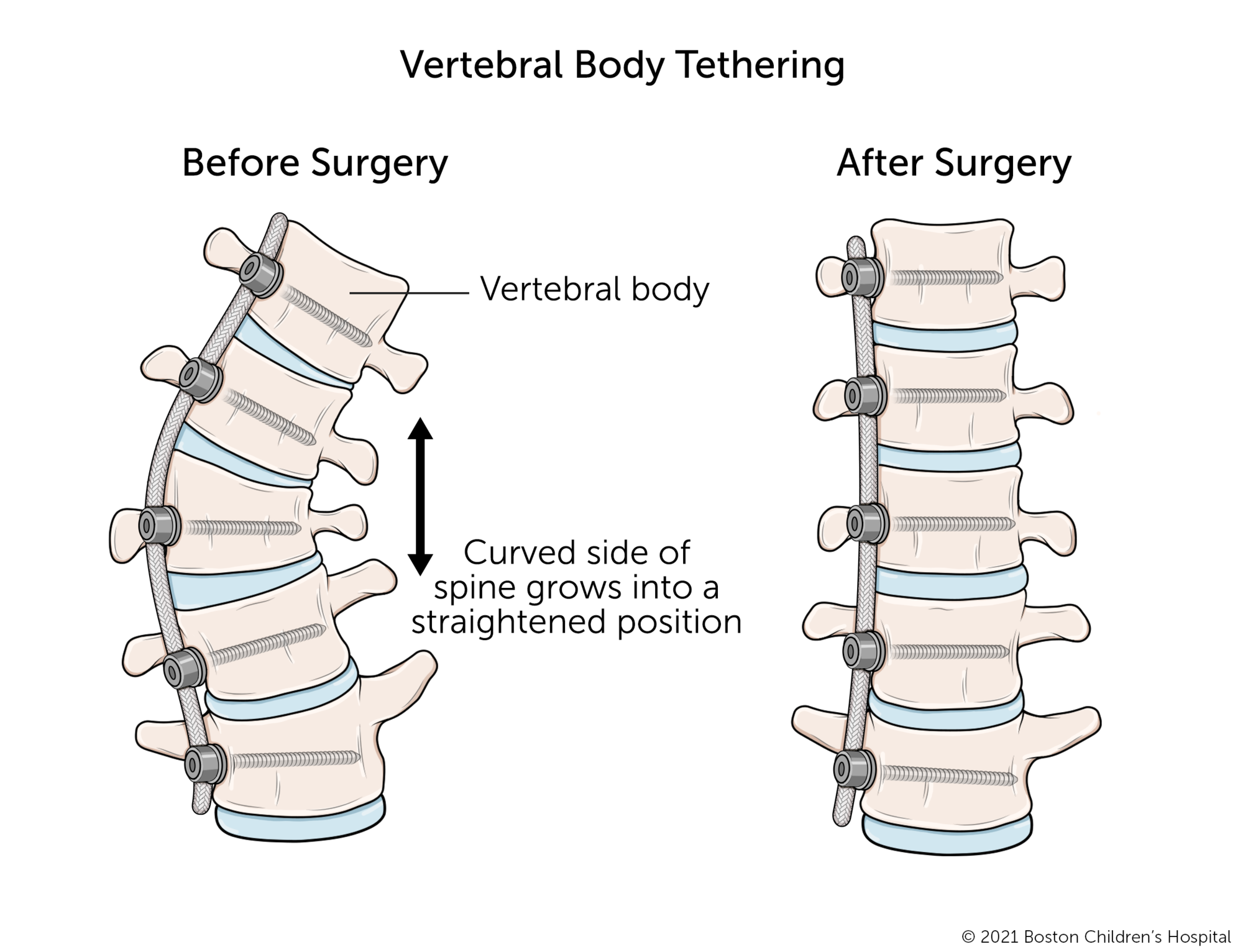 A before and after illustration of vertebral body tethering.