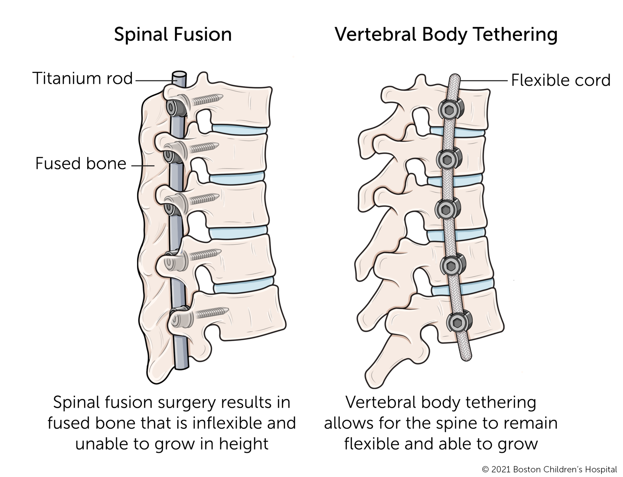 Spinal fusion compared to vertebral body tethering.