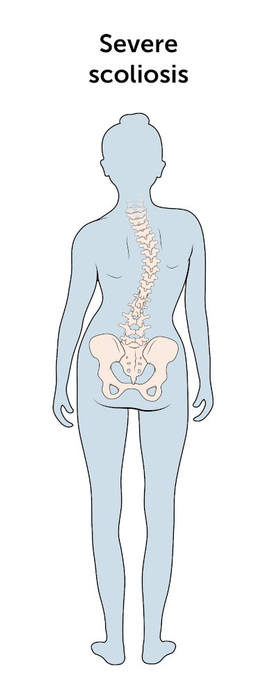 In severe scoliosis, the spine curves sideways at an angle of 45 degrees or more.
