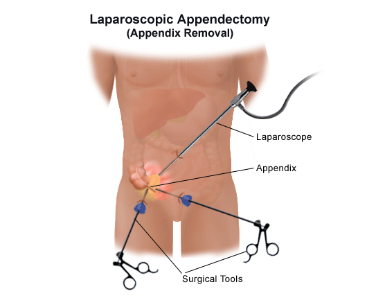 A laparascope is inserted into the child and navigate to the appendix. Surgical tools help remove the appendix.
