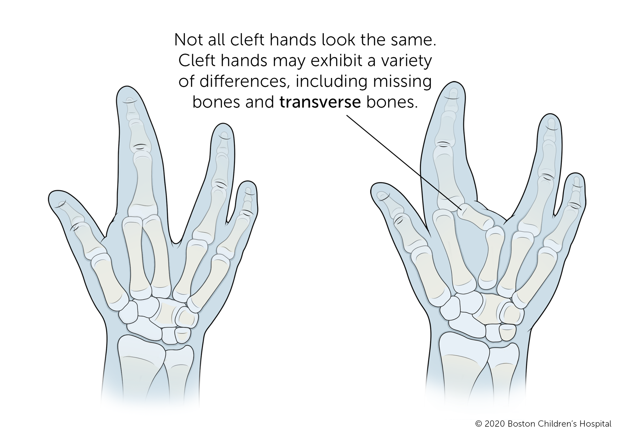 Not all cleft hands look the same. Cleft hands may exhibit a variety of differences, including missing bones and transverse bones.