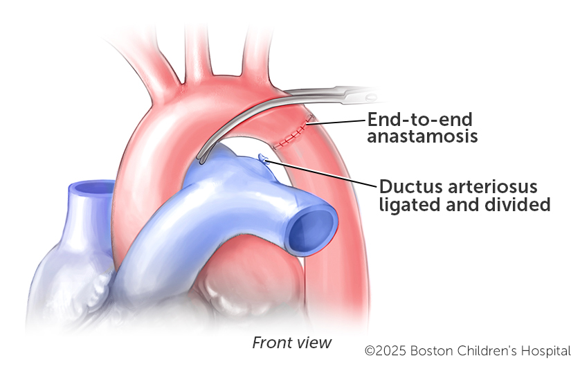 Medical illustration of two of the steps in the surgical repair of simple coarctation of the aorta.
