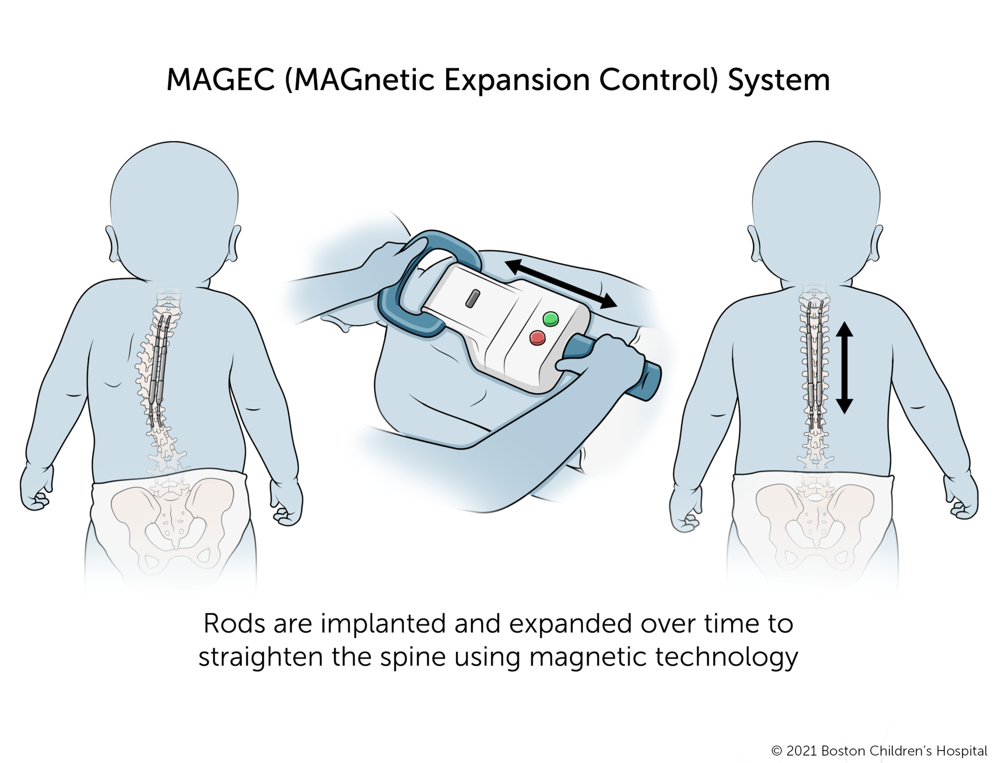 The MAGEC (Magnetic Expansion Control System). Implanted rods are slowly expanded with magnetic technology to straighten the spine over time.