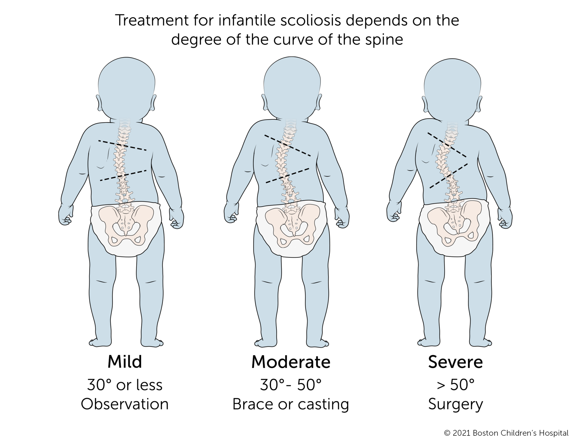 Comparison of mild, moderate, and severe infantile scoliosis.
