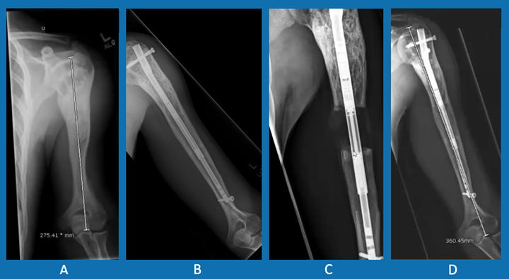Left humerous lengthening process