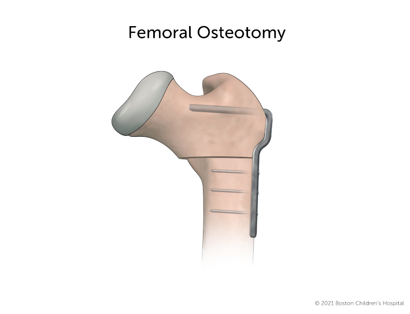 A femoral head after a femoral osteotomy. The bone has been cut and the top of the femoral head has been repositioned so it will fit more securely in the hip socket. The two pieces of bone are held together with a metal plate.