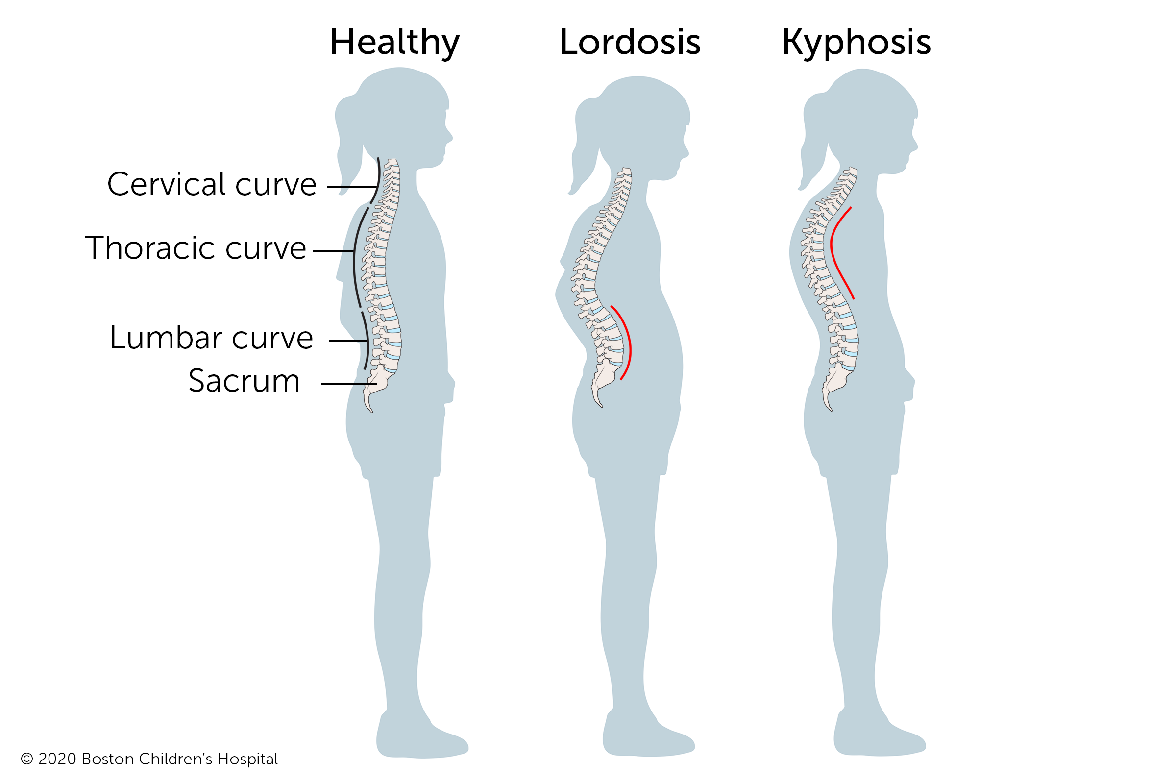 With kyphosis, the spine curves too far back, creating a hunchback appearance. With Lordosis, the spine curves too far forward.