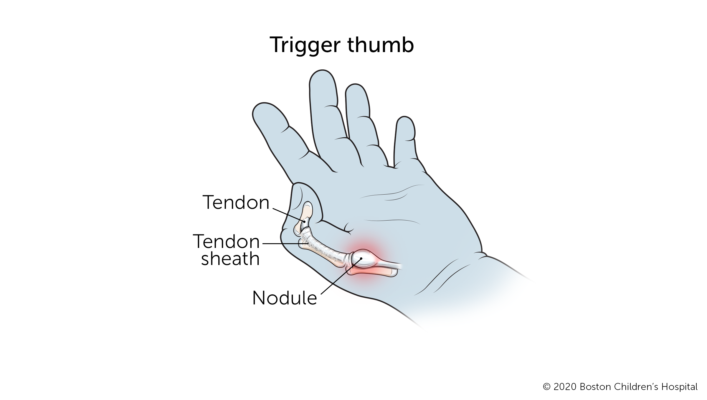 Trigger thumb: A nodule forms in the tendon at the base of the thumb when the tendon becomes too large to move easily inside the sheath that protects it. The thumb becomes stuck in a flexed position.