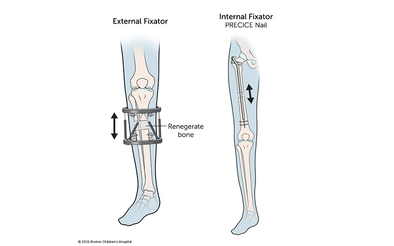 Two leg-lengthening devices: An external fixator circles the leg and is attached to the two ends of the bone with screws. The internal fixator (PRECICE Nail) is implanted inside the bone and extends from the top of the thigh bone almost to the top of the 