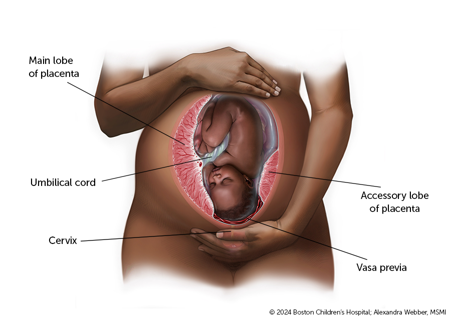 Medical illustration of vasa previa showing unprotected blood vessels from the placenta pass over or near the cervix.