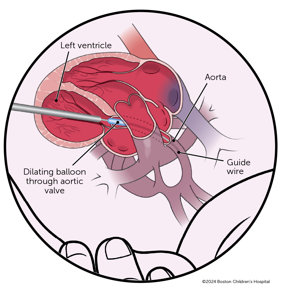 An illustration shows a fetal heart during an intervention. A balloon catheter treats aortic valve stenosis, improving blood flow.