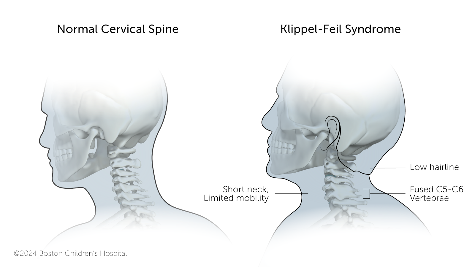 Due to fusion of vertebrae in the cervical spine, Klippel-Feil syndrome causes a shortened neck and low hairline.