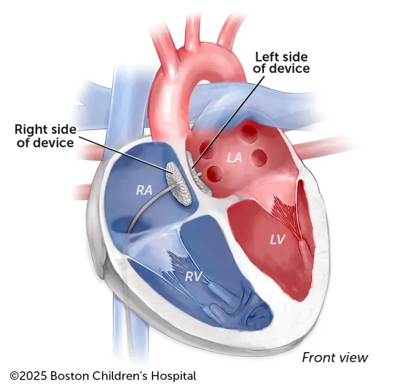 A medical illustration of a device closing the hole caused by a heart defect.