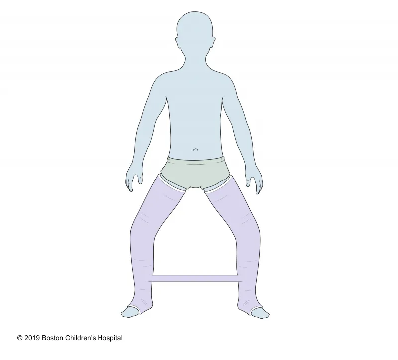Illustration of a child standing with legs apart, wearing tall, light purple leg casts and a band connecting both casts at the ankles. © 2019 Boston Childrens Hospital.