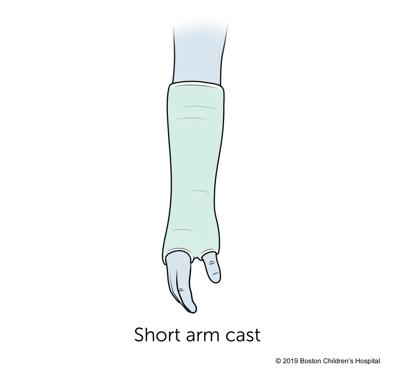 Illustration of a forearm wearing a short arm cast that covers from below the elbow to the hand, leaving the thumb and fingers exposed. Text below reads: Short arm cast.