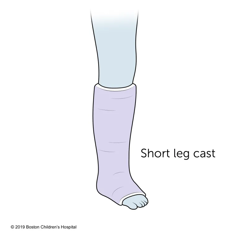 Illustration of a lower leg wearing a light purple short leg cast, covering from just below the knee to the toes. The label "short leg cast" is written beside the cast.