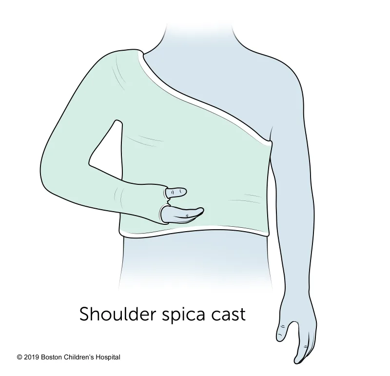 Illustration of a person wearing a shoulder spica cast, which covers the upper torso, shoulder, and arm, immobilizing the arm across the body. Text reads: Shoulder spica cast.