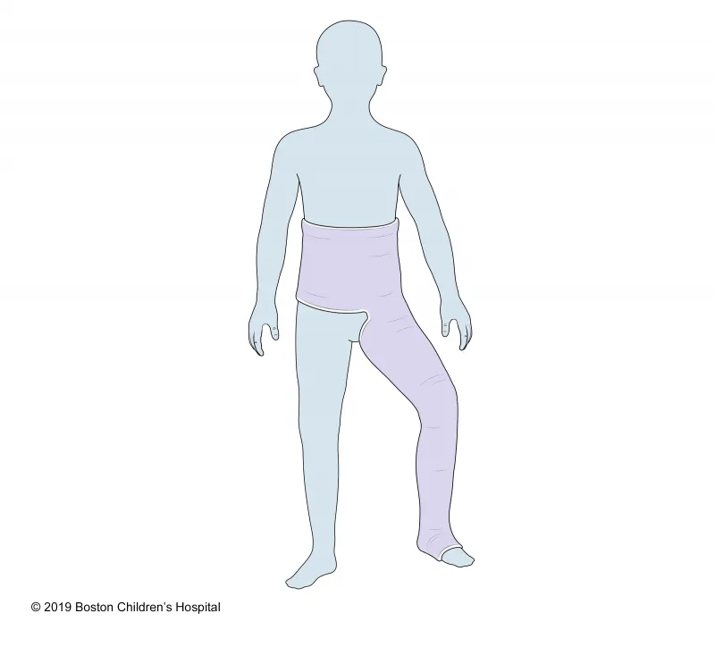Illustration of a child with a cast covering the pelvis and extending down the right leg, indicating a hip spica cast. The cast covers the waist, hip, and entire leg down to the foot.