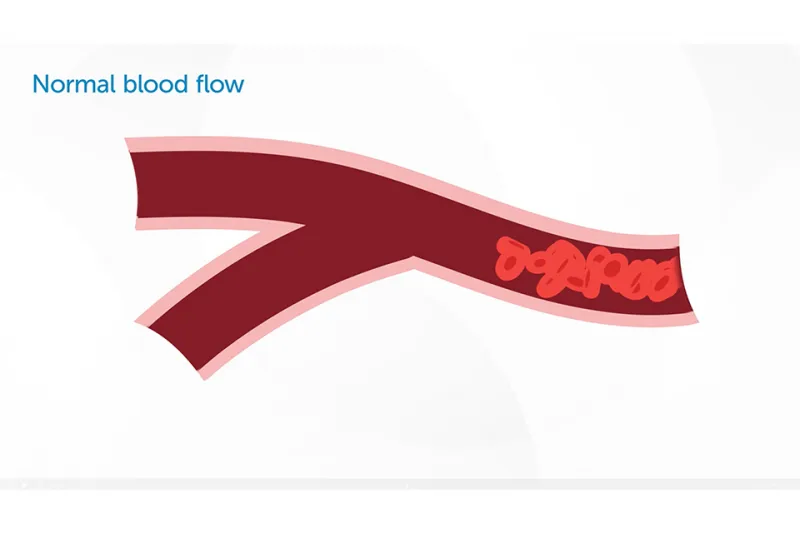 Diagram labeled "Normal blood flow" showing red blood cells moving through a Y-shaped blood vessel.