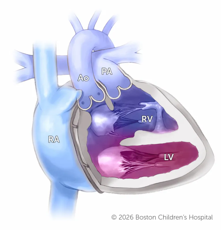 Superior-Inferior Ventricles | Boston Children's Hospital