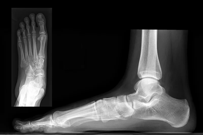 An X-ray image of flatfoot