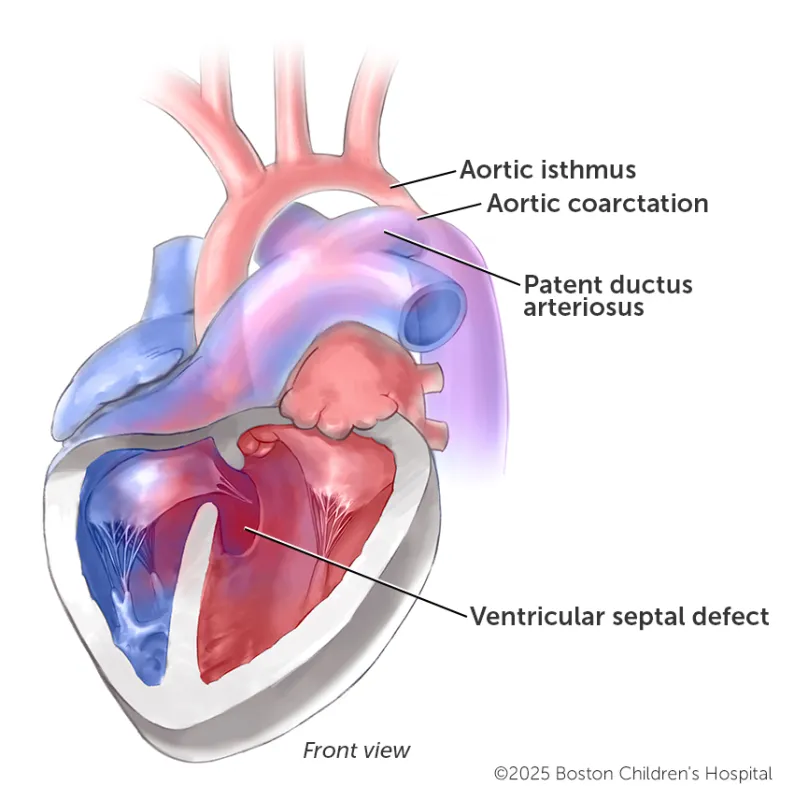Medical illustration of coarctation of the aorta with ventricular septal defect.