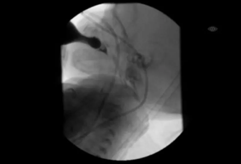 Imaging from modified barium swallow study