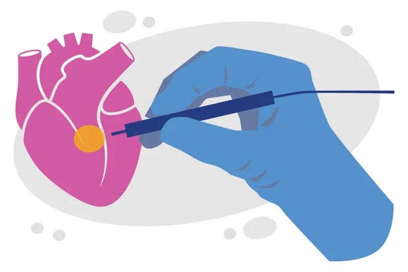 Illustration of surgeon holding small tool near heart