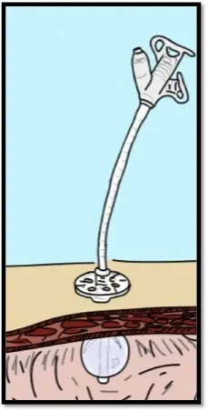 Illustration of MIC-G™ tube inserted into stomach