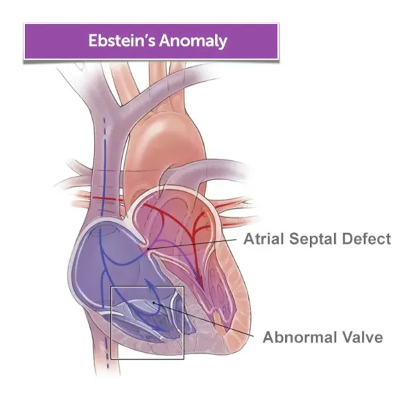 Illustration of a heart with Ebstein's anomaly