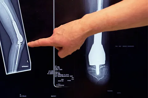 Clinician points to medical imaging showing tumor on knee